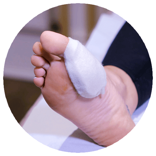 Hapla Circle Hallux